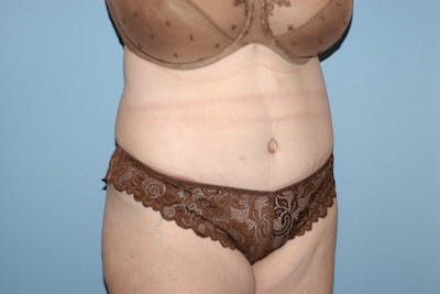 Tummy Tuck Before & After Gallery - Patient 9568148 - Image 4