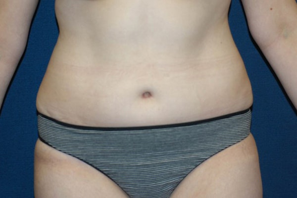 Tummy Tuck Before & After Gallery - Patient 9568149 - Image 2