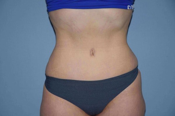 Tummy Tuck Before & After Gallery - Patient 9568157 - Image 2