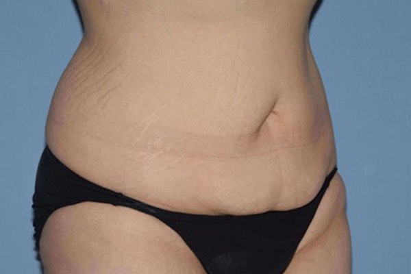 Tummy Tuck Before & After Gallery - Patient 9568157 - Image 3