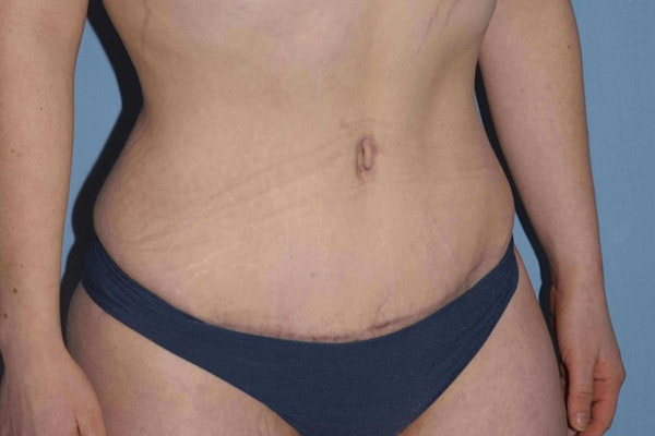 Tummy Tuck Before & After Gallery - Patient 9568157 - Image 4