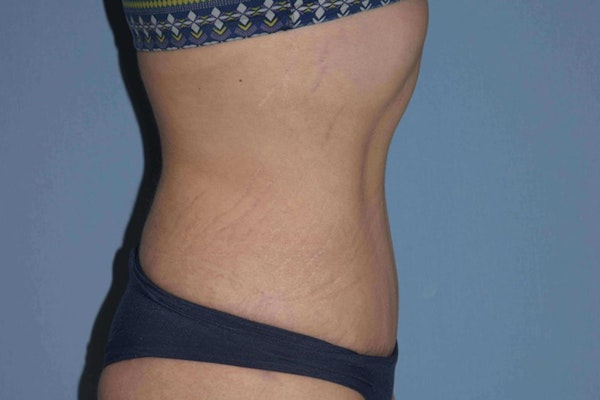 Tummy Tuck Before & After Gallery - Patient 9568157 - Image 6