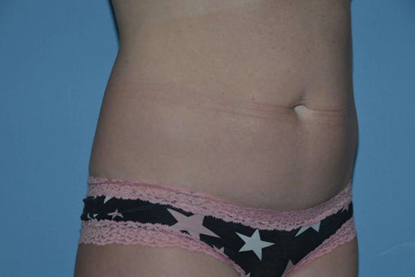 Tummy Tuck Gallery - Patient 9568160 - Image 3