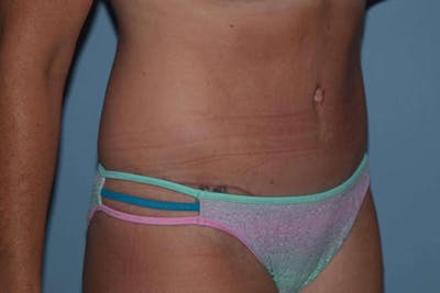 Tummy Tuck Before & After Gallery - Patient 9568160 - Image 4