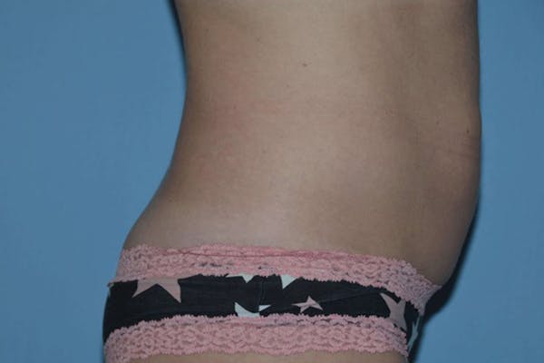 Tummy Tuck Gallery - Patient 9568160 - Image 5