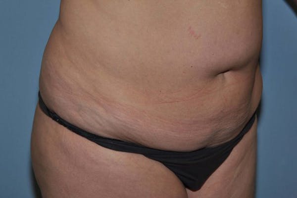 Tummy Tuck Before & After Gallery - Patient 9568162 - Image 3