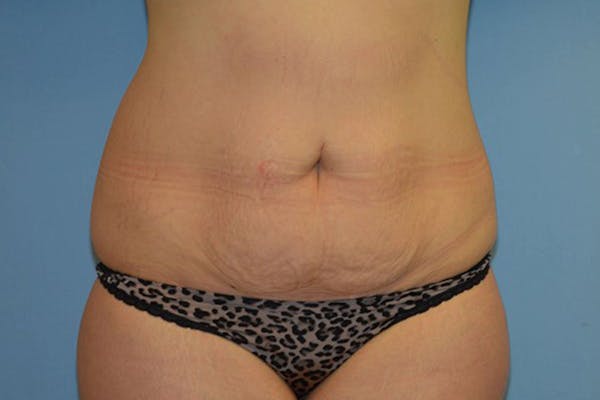 Tummy Tuck Before & After Gallery - Patient 9568165 - Image 1