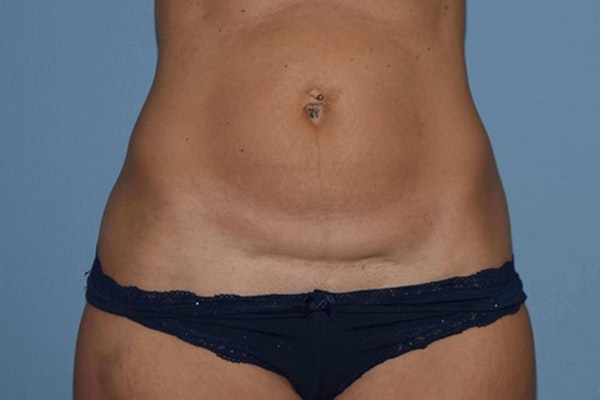 Tummy Tuck Before & After Gallery - Patient 9568184 - Image 1
