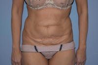 Tummy Tuck Before & After Gallery - Patient 9568201 - Image 1