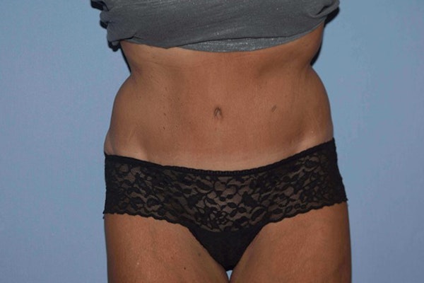 Tummy Tuck Before & After Gallery - Patient 9568201 - Image 2