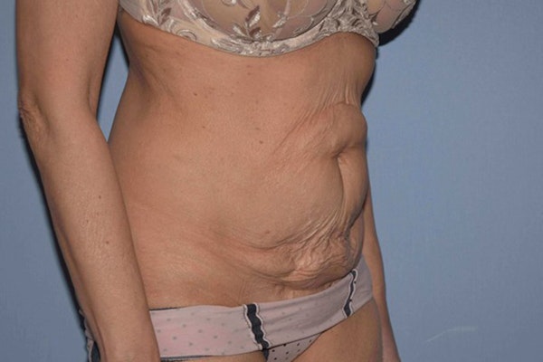 Tummy Tuck Before & After Gallery - Patient 9568201 - Image 3