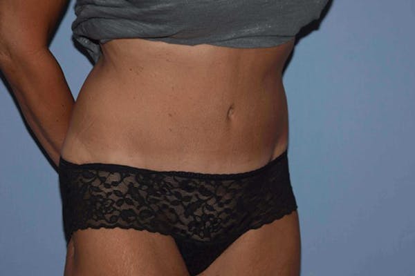 Tummy Tuck Gallery - Patient 9568201 - Image 4