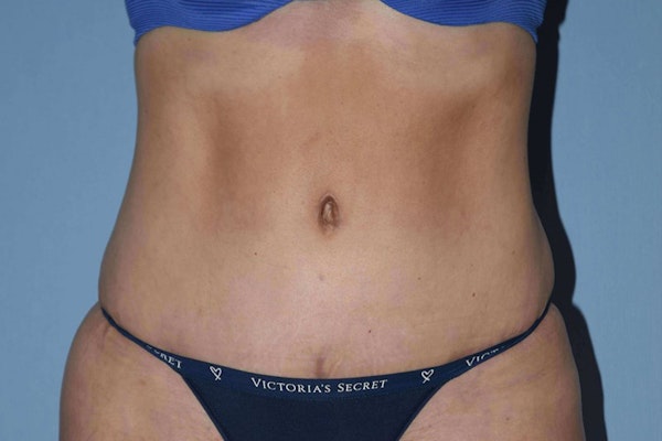 Tummy Tuck Before & After Gallery - Patient 14281233 - Image 4