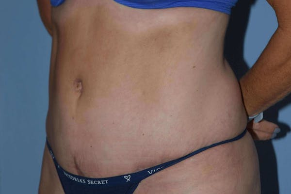 Tummy Tuck Before & After Gallery - Patient 14281233 - Image 6