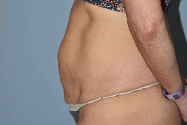 Tummy Tuck Before & After Gallery - Patient 14281233 - Image 7