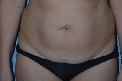 Tummy Tuck Before & After Gallery - Patient 14281270 - Image 1
