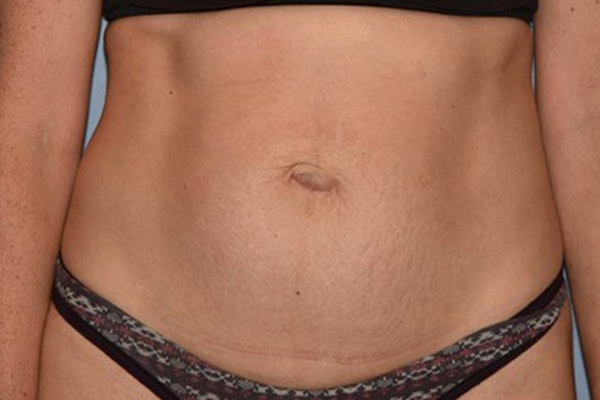 Tummy Tuck Before & After Gallery - Patient 14281278 - Image 1
