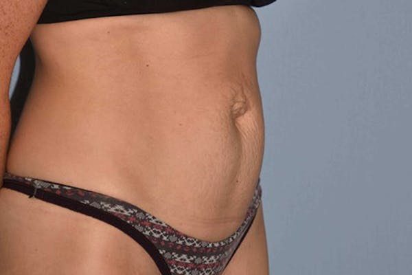 Tummy Tuck Gallery - Patient 14281278 - Image 3