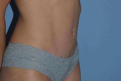 Tummy Tuck Before & After Gallery - Patient 14281278 - Image 4