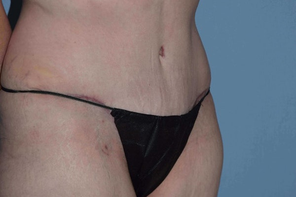 Tummy Tuck Before & After Gallery - Patient 14281280 - Image 4