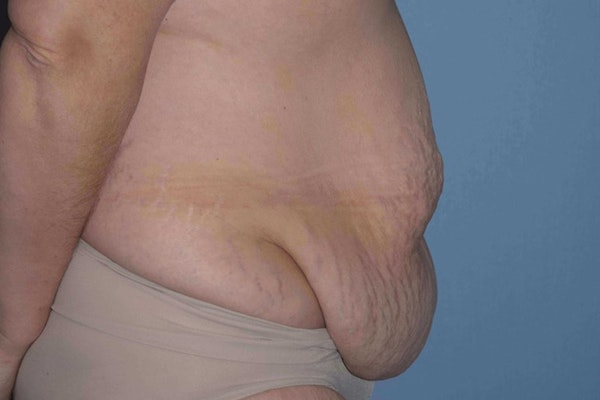 Tummy Tuck Before & After Gallery - Patient 14281280 - Image 5