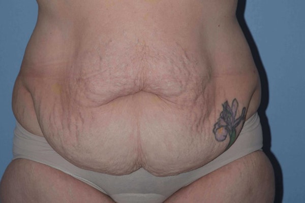 Tummy Tuck Before & After Gallery - Patient 14281280 - Image 1
