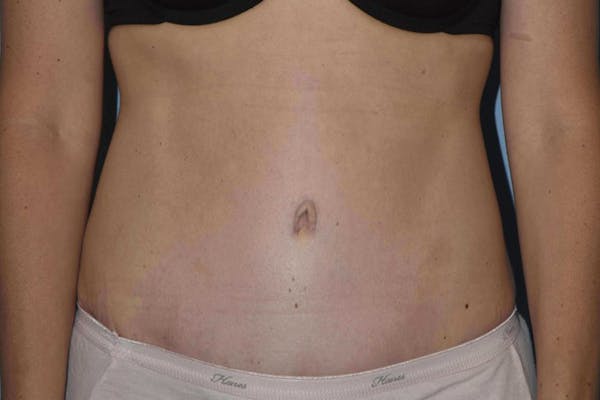 Tummy Tuck Gallery - Patient 14281284 - Image 2