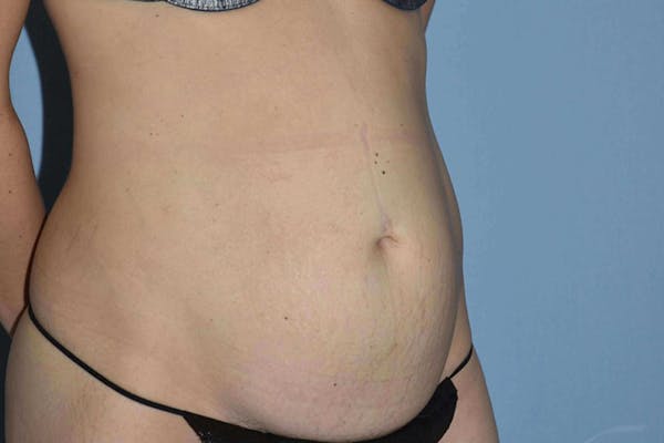 Tummy Tuck Gallery - Patient 14281284 - Image 3