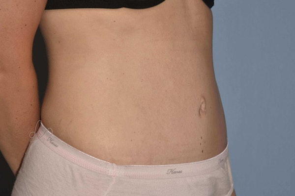 Tummy Tuck Before & After Gallery - Patient 14281284 - Image 4