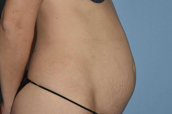 Tummy Tuck Before & After Gallery - Patient 14281284 - Image 5