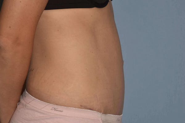 Tummy Tuck Gallery - Patient 14281284 - Image 6