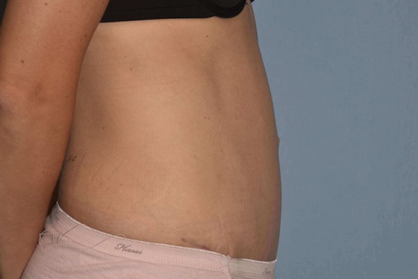 Tummy Tuck Before & After Gallery - Patient 14281284 - Image 6