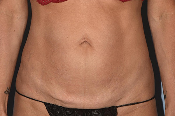 Tummy Tuck Before & After Gallery - Patient 17229331 - Image 1