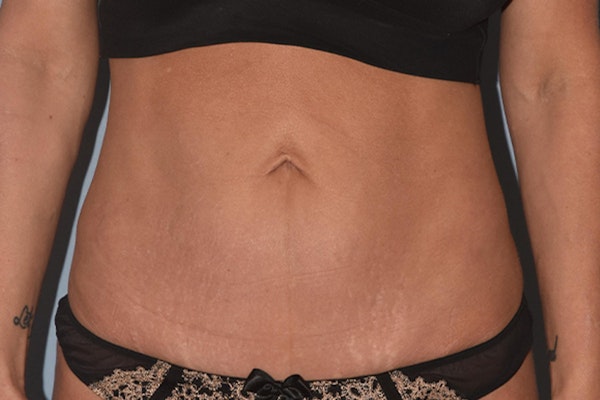 Tummy Tuck Before & After Gallery - Patient 17229331 - Image 2