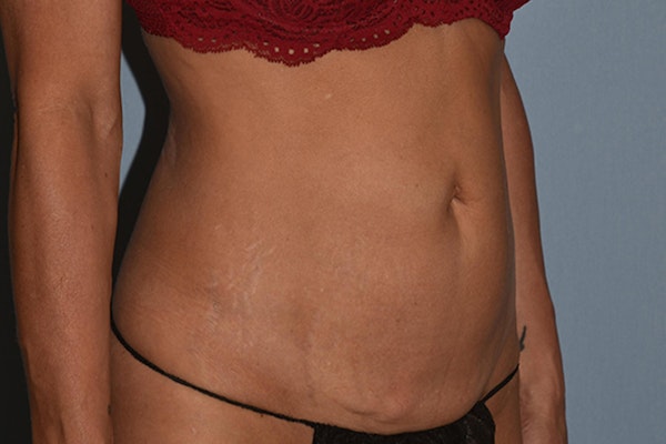Tummy Tuck Before & After Gallery - Patient 17229331 - Image 3