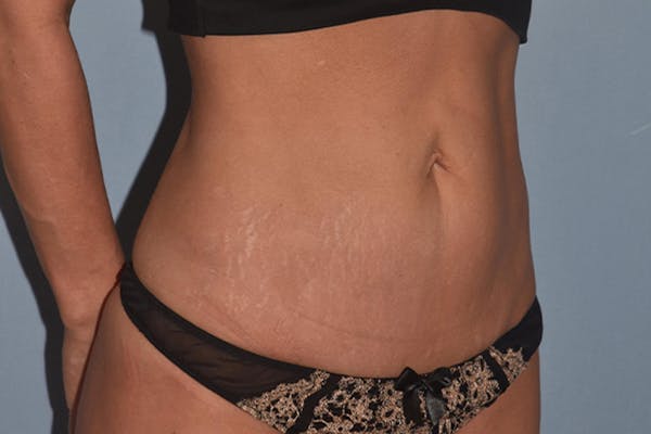 Tummy Tuck Before & After Gallery - Patient 17229331 - Image 4