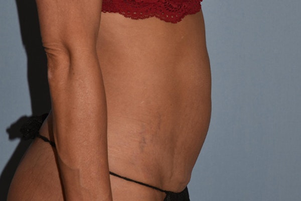 Tummy Tuck Before & After Gallery - Patient 17229331 - Image 5