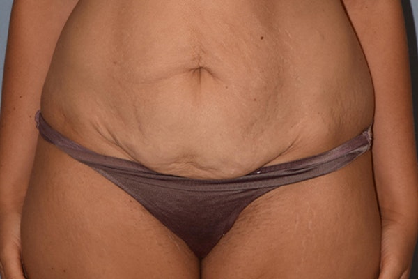Tummy Tuck Before & After Gallery - Patient 17336062 - Image 1