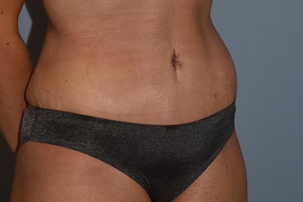 Tummy Tuck Gallery - Patient 17336062 - Image 4