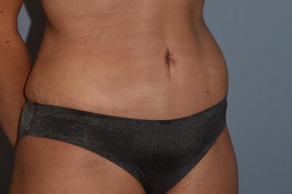Tummy Tuck Before & After Gallery - Patient 17336062 - Image 4