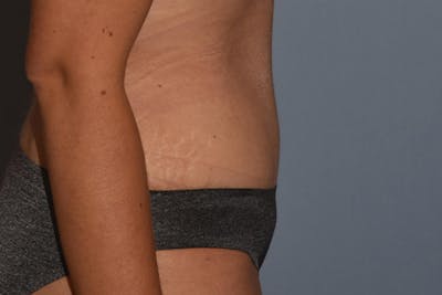 Tummy Tuck Before & After Gallery - Patient 17336062 - Image 6