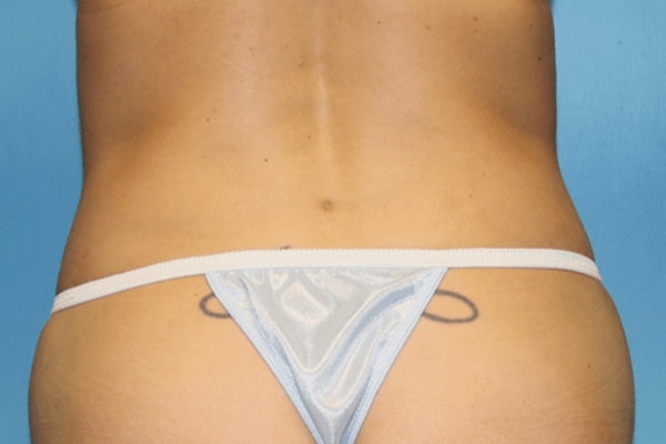Liposuction Before & After Gallery - Patient 14281437 - Image 4