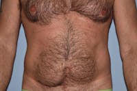 Liposuction Before & After Gallery - Patient 14281445 - Image 1