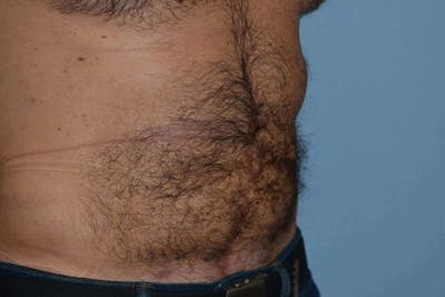 Liposuction Before & After Gallery - Patient 14281445 - Image 4