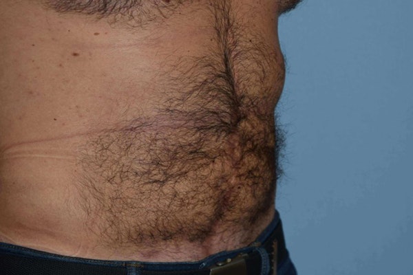 Liposuction Before & After Gallery - Patient 14281445 - Image 4