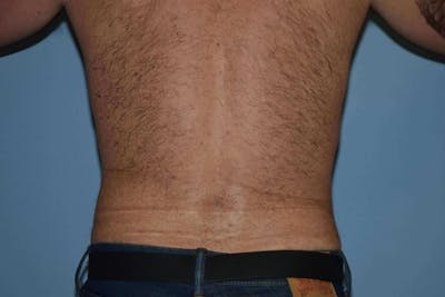 Liposuction Before & After Gallery - Patient 14281445 - Image 6