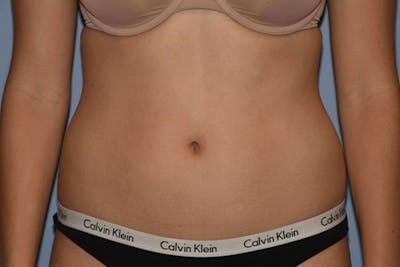 Liposuction Gallery - Patient 14281446 - Image 1