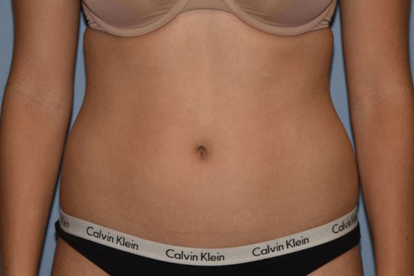 Liposuction Before & After Gallery - Patient 14281446 - Image 1