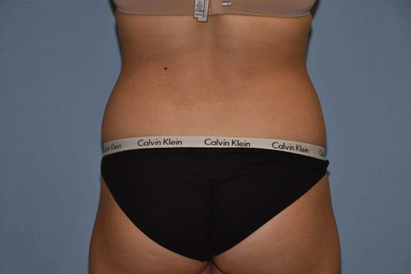 Liposuction Before & After Gallery - Patient 14281446 - Image 3