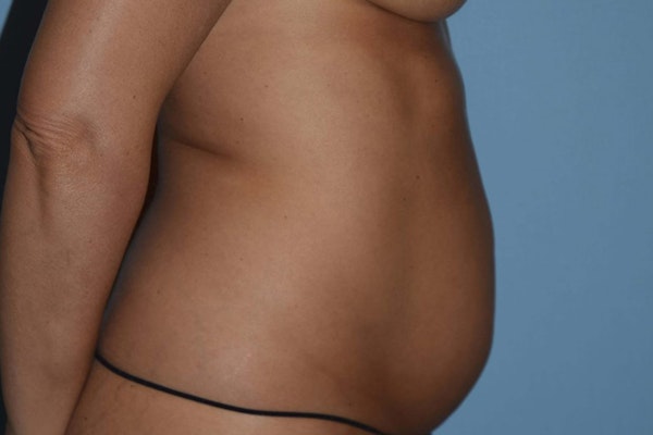 Liposuction Before & After Gallery - Patient 14281448 - Image 3